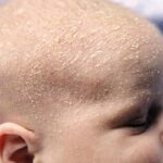 کرم برطرف کننده پوسته های چرب سر نوزاد 30میل هیدرودرم - تصویر 4